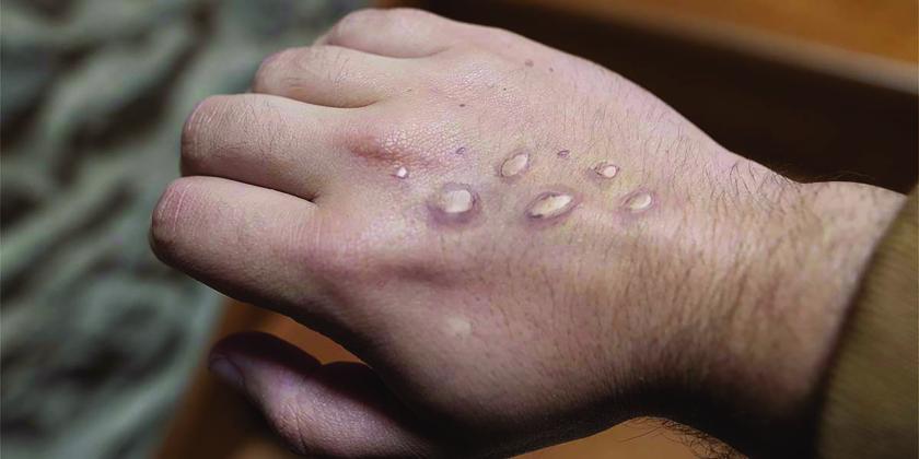 Monkeypox marks on a hand 