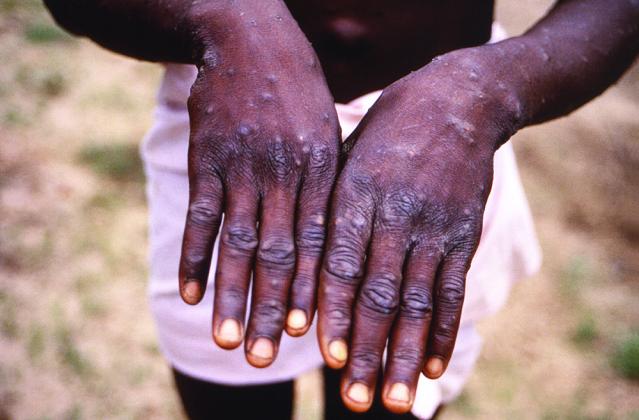 Monkey Pox 